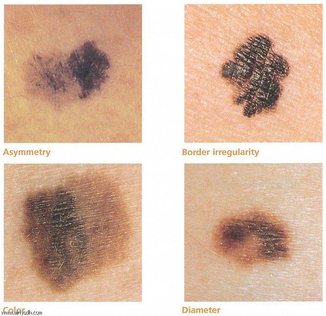 الأشعة فوق البنفسجية (UV).. السبب الرئيس للإصابة بسرطان الجلد