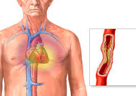 أسباب وعلاج مرض تضيق الشريان الأبهر
