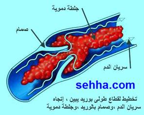 متلازمة اضداد الدهون الفوسفورية (Anti phospholipids)