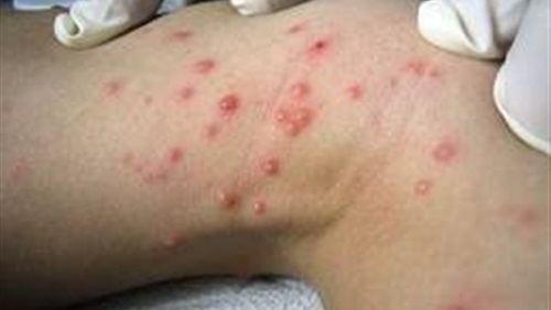 مرض المليساء المعدية ” Molluscum Contagiosum ” الاسباب و العلاج