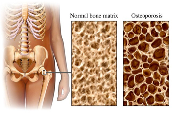 Mythes et faits sur l'ostéoporose