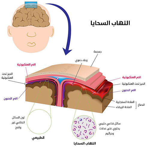 العلاجات المنزلية لمرض إلتهاب السحايا