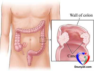 العلاجات المنزلية المفيدة للمساعدة في علاج مرض سرطان القولون
