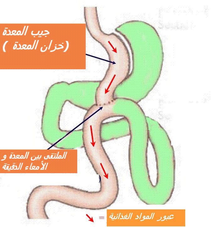 ما هي متلازمة الأمعاء المتسربة ؟