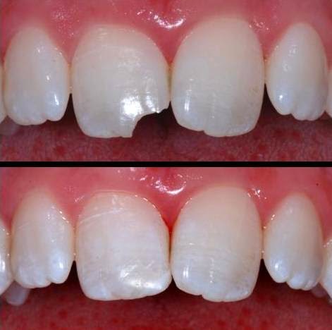 أسباب تآكل الأسنان Dental Erosion