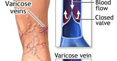 نصائح لتغلب على اضطرابات الدورة الدموية في الساقين
