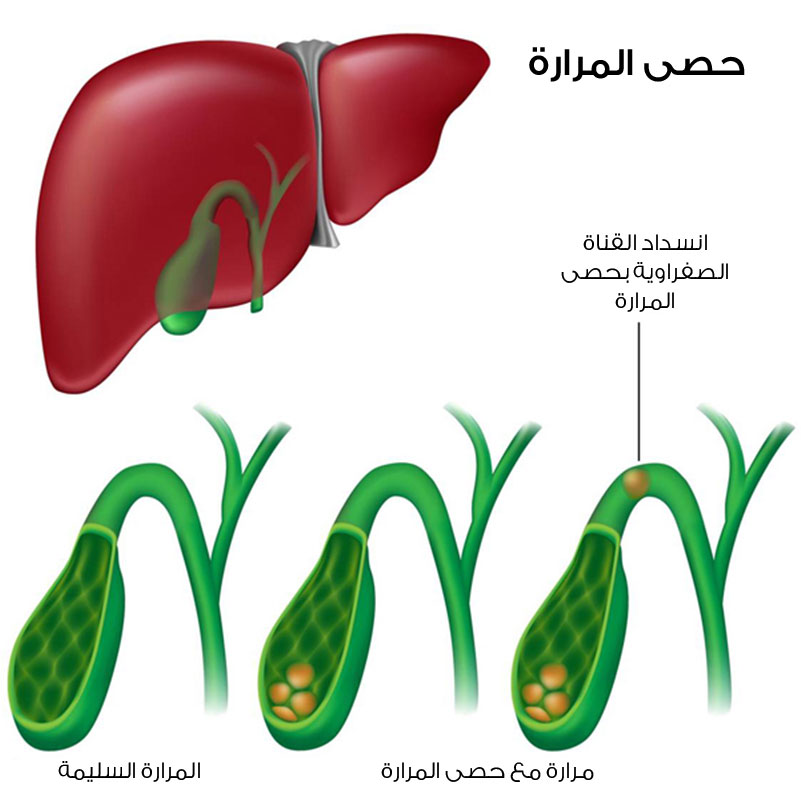 أسباب تكون حصوات المرارة ؟