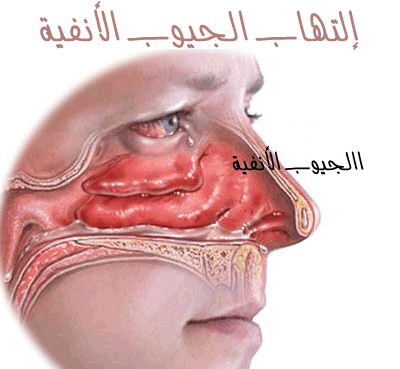 اسباب التهاب الجيوب الانفية واهم طرق الوقاية