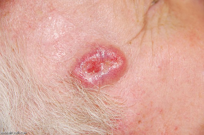 الأشعة فوق البنفسجية (UV).. السبب الرئيس للإصابة بسرطان الجلد