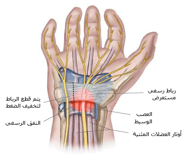 ماذا تعرف عن متلازمة عظام الرسغ MPS