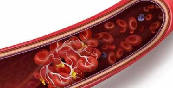 تعرف على 5 أطعمة تسبب جلطات دموية خطيرة